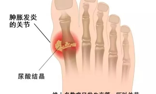肺结核病人能吃老鹅吗好吗-权威肺结核可以吃平台,分享专业肺结核病人能吃桃子吗?知识_肺结核病人能吃老鹅吗网